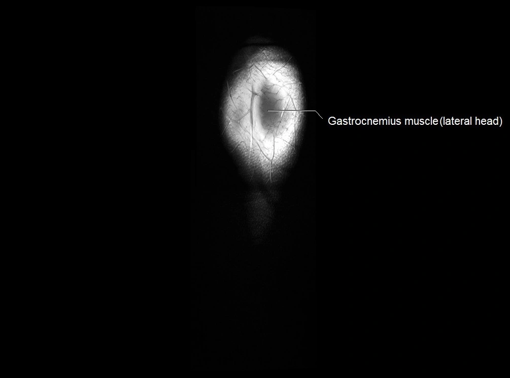 MRI 3T leg (tibia & fibula) labelled coronal cross sectional anatomy image 30.webp